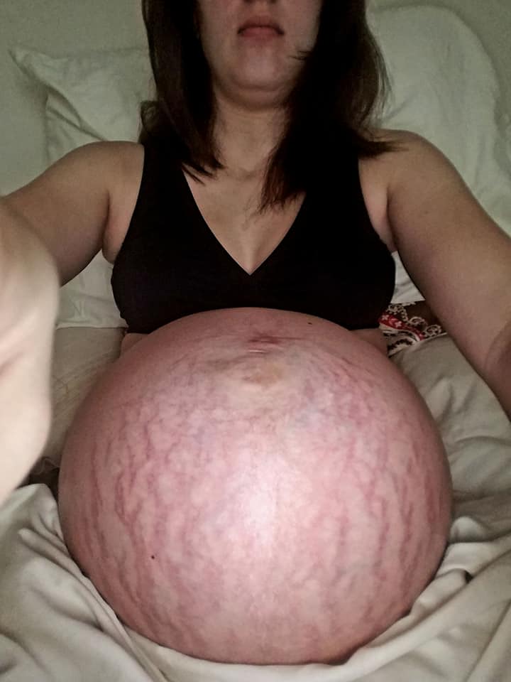 The enormous twin pregnancy belly
